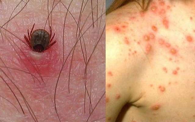 أمراض جرثومة و بكتيريا الريكتيسيا