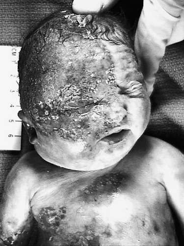 إنتان الجنين و حديث الولادة بفيروس الحلأ البسيط