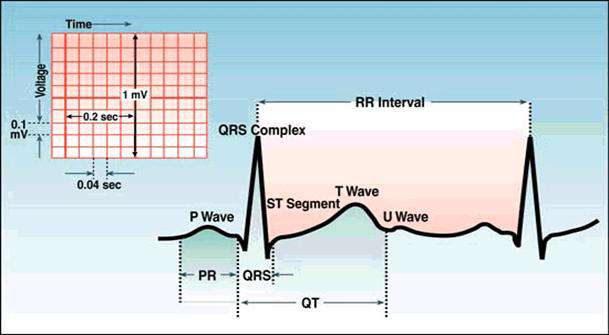 اضطراب نظم القلب عند الطفل - خلل ضربات القلب على ECG