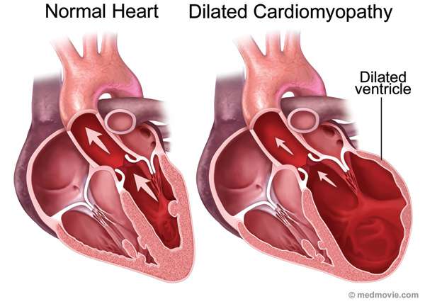 اعتلال العضلة القلبية التوسعي او التمددي عند الاطفال