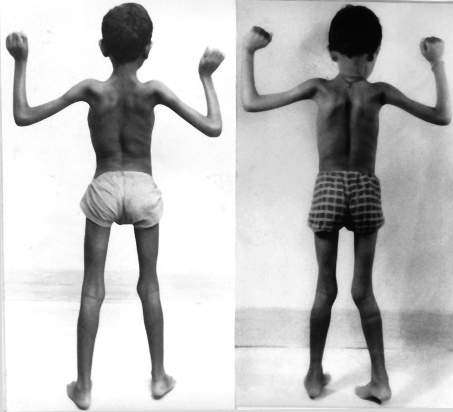 اعتلال و حثل العضلات عند الأطفال و الرضع