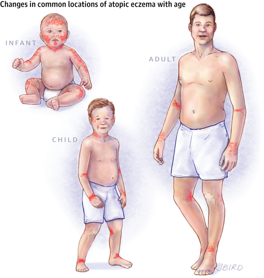  الأكزيما عند الأطفال و الرضع