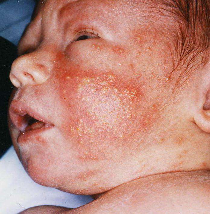 الأمراض الجلدية التي تصيب الأطفال حديثي الولادة