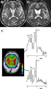 الأمراض العصبية التنكسية عند الاطفال و الرضع