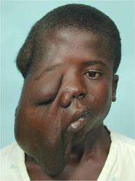 الأورام الليفية العصبية عند الأطفال