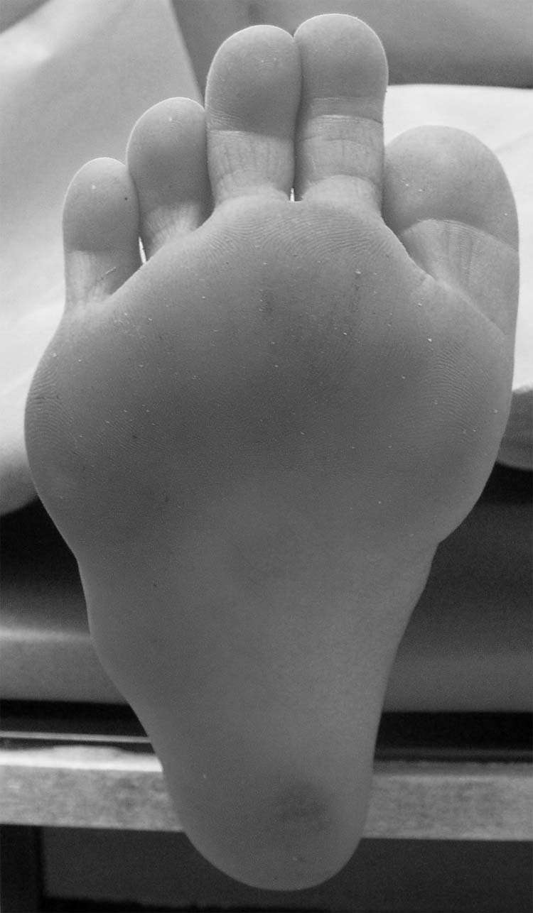 الإبهام الأروح الولادي