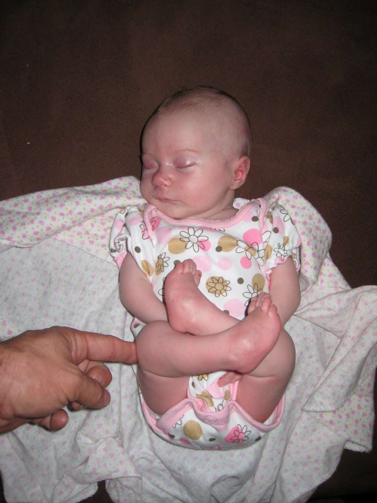 الاعوجاج المفصلي المتعدد الخلقي