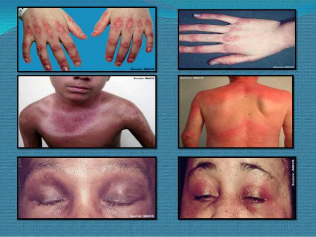 التهاب الجلد و العضلات عند الأطفال و المراهقين