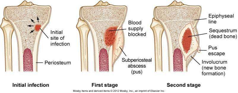التهاب العظم و نقي العظم و المفصل البكتيري عند الاطفال و الرضع