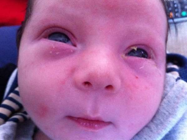 التهاب العين و الملتحمة للطفل حديث الولادة