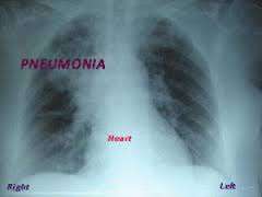 التهاب رئة الطفل بجرثومة و بكتيريا الميكوبلازما الرئوية