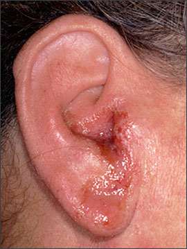 التهاب مجرى السمع و الأذن الخارجية عند الأطفال و الرضع