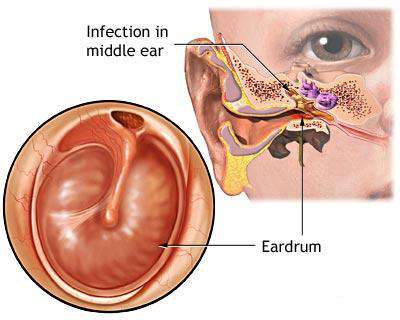 التهابات الأذن الوسطى عند الاطفال