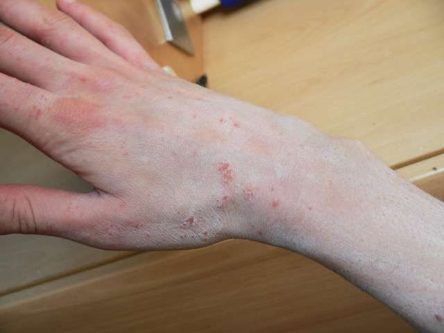 الجرب او سوس الجلد