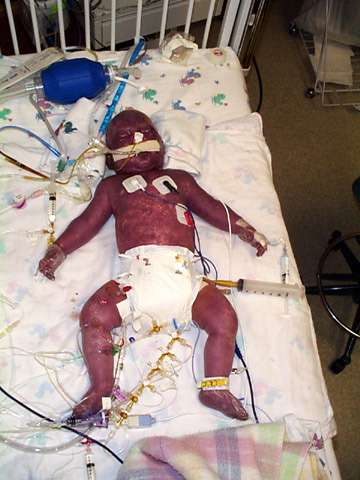 الخثار أو التخثر المنتشر داخل الأوعية عند الأطفال و الرضع و حديثي الولادة