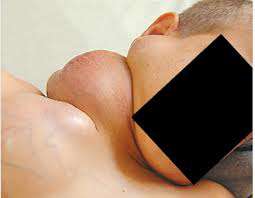 الداء الحبيبي او الحبيبومي المزمن عند الاطفال