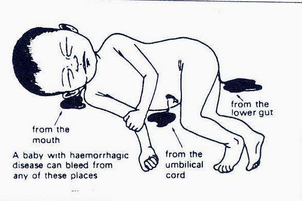 الداء النزفي عند الوليد