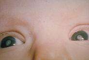 الساد الخلقي أو الولادي عند الاطفال congenital cataract
