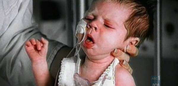  السعال الديكي عند الرضع و الاطفال