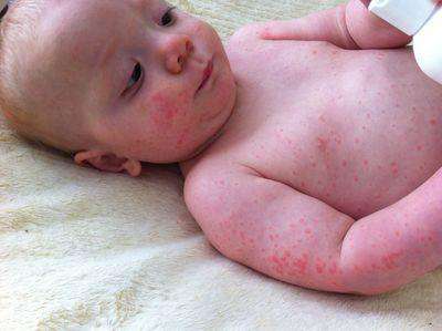 الطفح الجلدي الفيروسي عند الاطفال