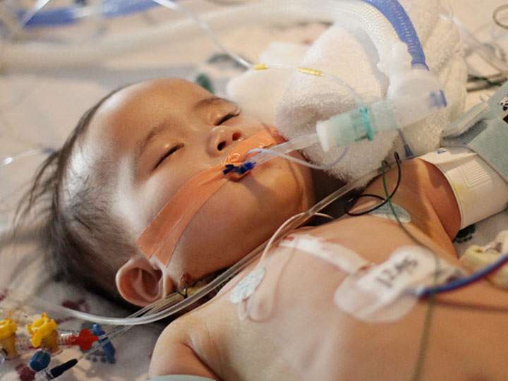 الفشل و القصور التنفسي عند الأطفال و الرضع