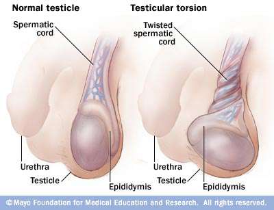 الم و تورم الخصية عند الاطفال و المراهقين