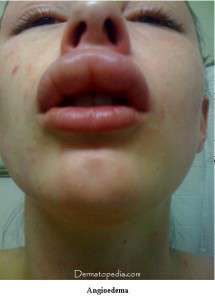 الوذمة الوعائية العصبية عند الأطفال:أسباب:أعراض:علاج