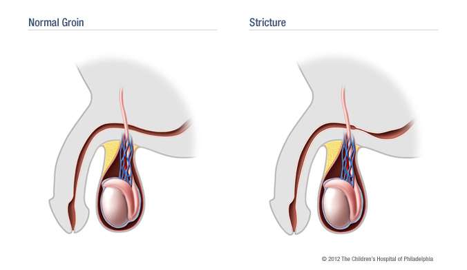 انسداد و تضيق مجرى البول او الاحليل عند الاطفال