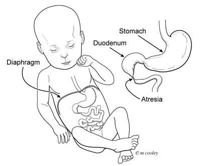 انسداد و رتق و تضيق العفج الولادي