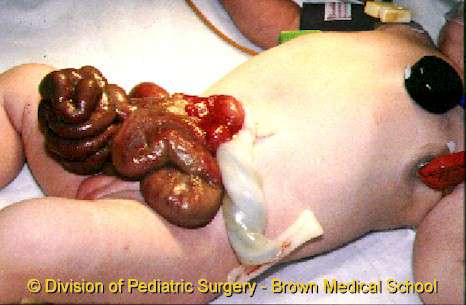 انشقاق و فلع جدار البطن عند الجنين و حديث الولادة