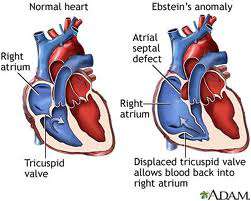 تشوه ابشتاين في القلب عند الاطفال