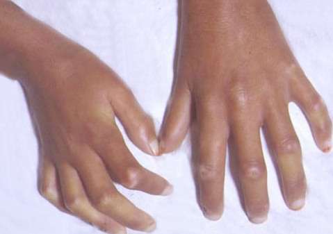  تصلب أو صلابة الجلد عند الأطفال و المراهقين