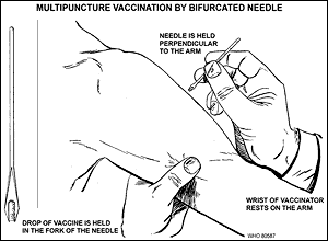 تطعيم و لقاح الجدري