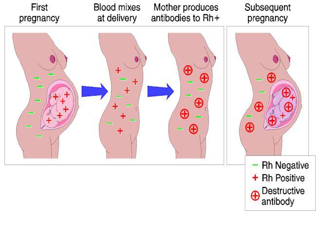 تنافر الزمر الدموية خلال الحمل