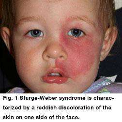 داء ستورج ويبر