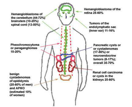 داء فون هيبل ليندو