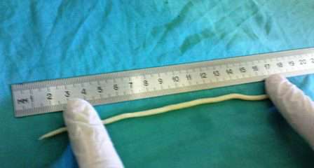 ديدان الأطفال : الاسكاريس