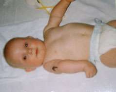 شلل إرب :رخاوة الذراع عند المولود بعد الولادة