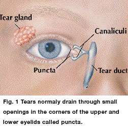 ضيق أو تضيق مجرى و قناة الدمع عند الأطفال
