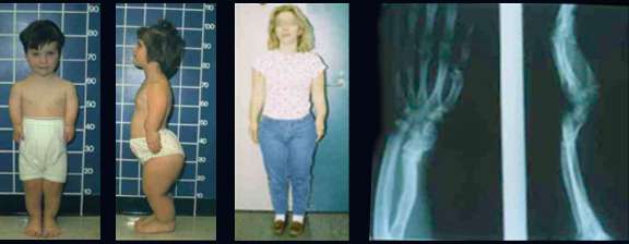 عسرات التصنع الغضروفية و الهيكلية عند الأطفال