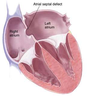 فتحة القلب بين الأذينين  atrial septal defect - ASD