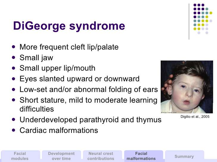 متلازمة دي جورج عند الأطفال و الرضع