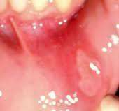 مرض القُلاع : اسباب,اعراض,علاج