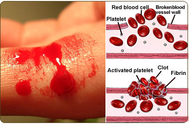 مرض فون ويليبراند