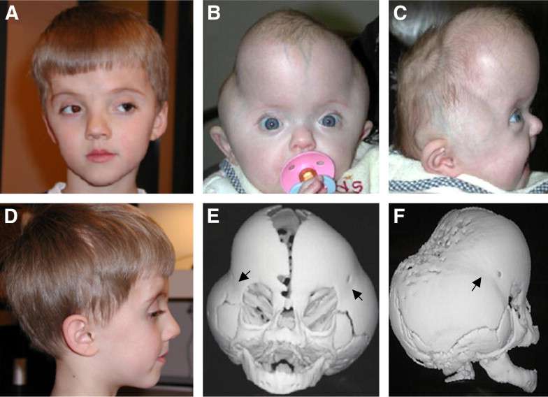 مشاكل شكل و حجم راس الطفل