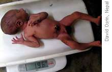 نقص وزن الجنين