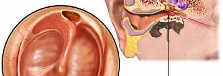 أعراض التهاب الأذن الوسطى عند الأطفال