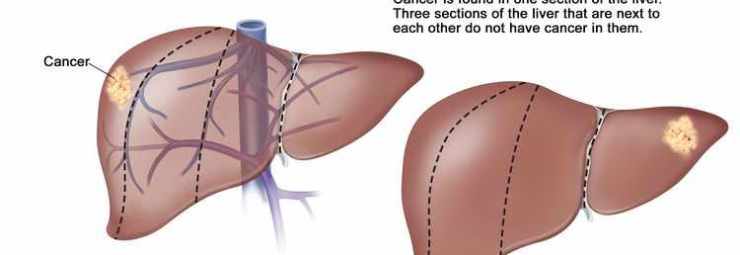 أنواع سرطان الكبد عند الاطفال