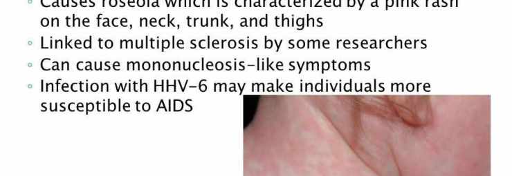 اعراض فيروس الهربس البشري نوع 6 و 7