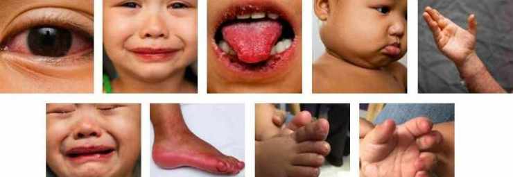اعراض مرض كاواساكي عند الاطفال